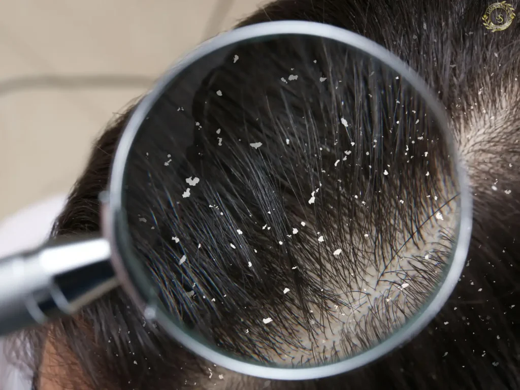 Hair Dandruff Treatment in Salon